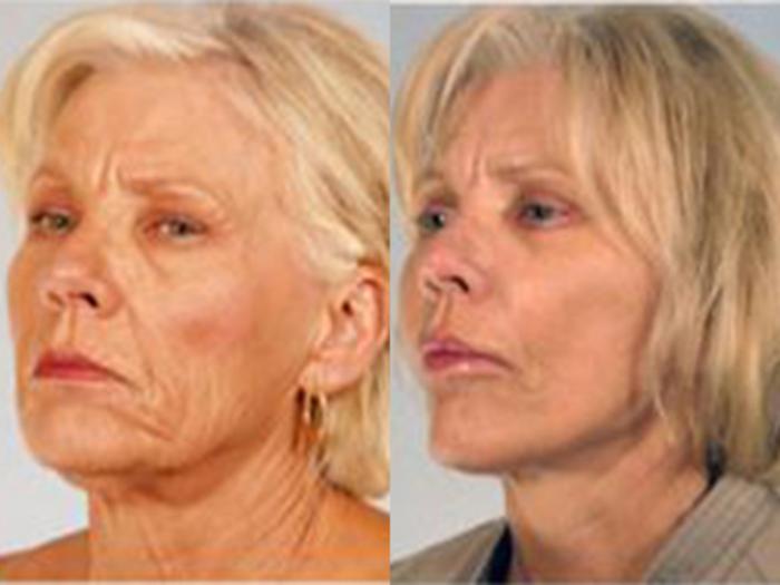 Before & After Facelift Case 5813 View 2 View in Houston, TX