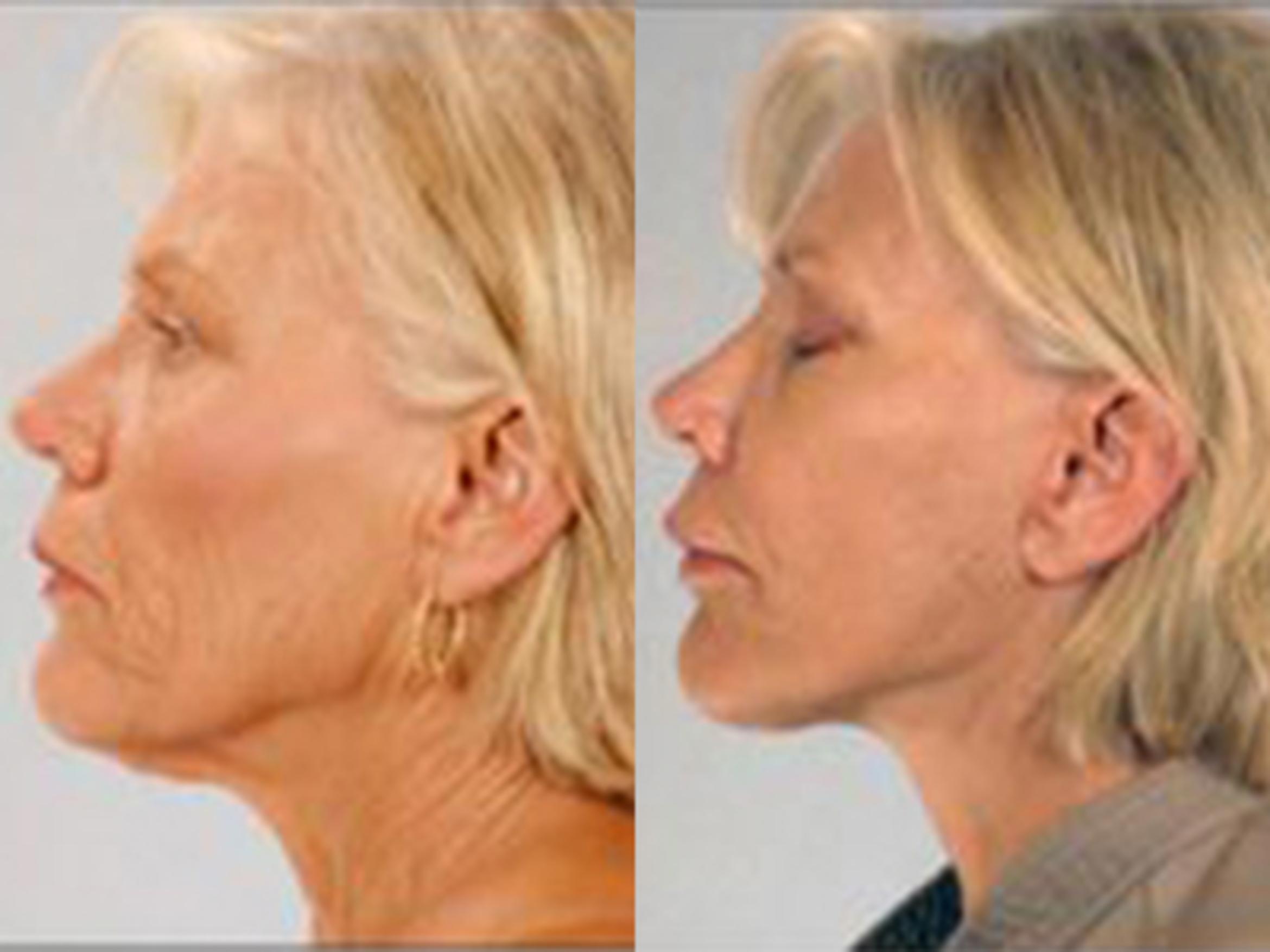 Before & After Facelift Case 5813 View 3 View in Houston, TX