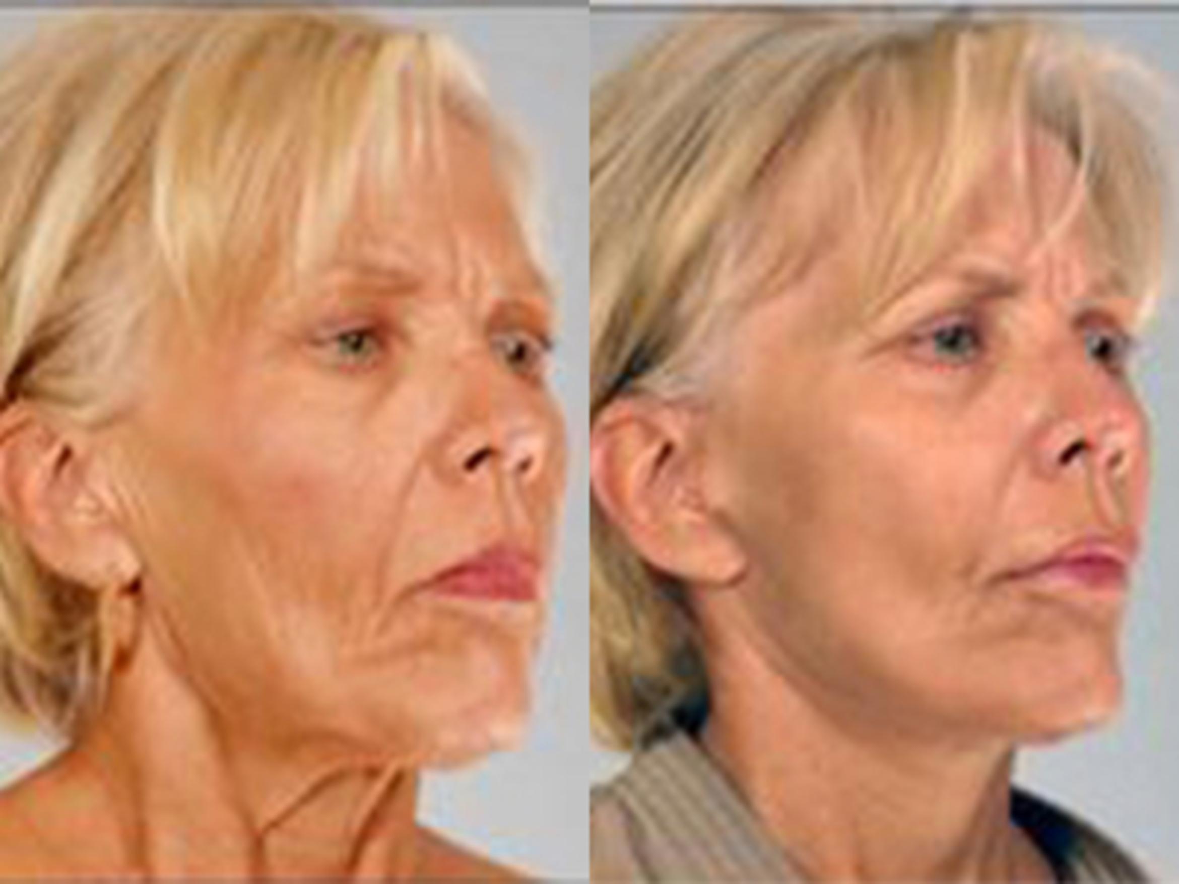 Before & After Facelift Case 5813 View 4 View in Houston, TX