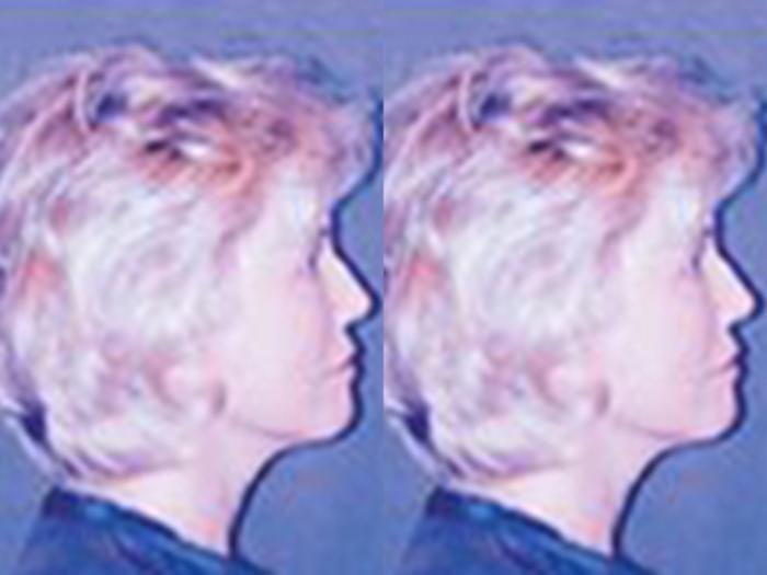 Before & After Facelift Case 5823 View 1 View in Houston, TX