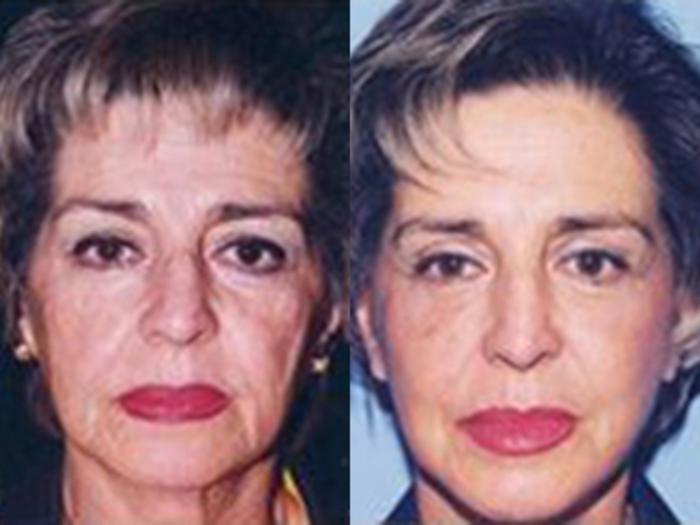 Before & After Facelift Case 5827 View 1 View in Houston, TX