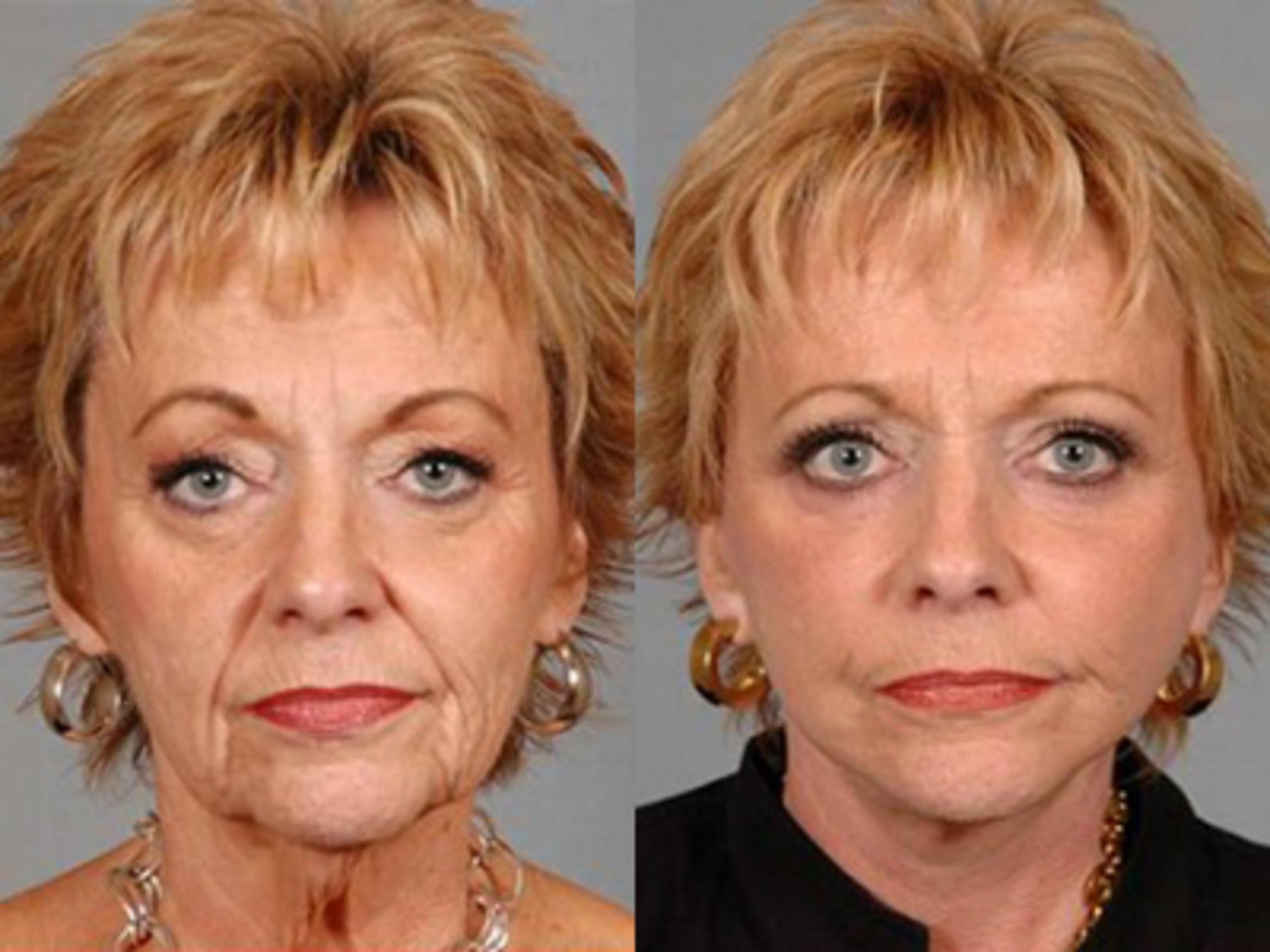 Before & After Facelift Case 58439999 View 1 View in Houston, TX