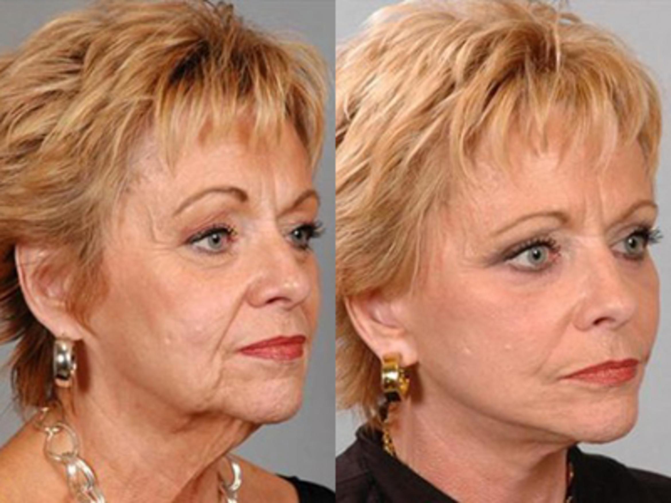 Before & After Facelift Case 58439999 View 2 View in Houston, TX