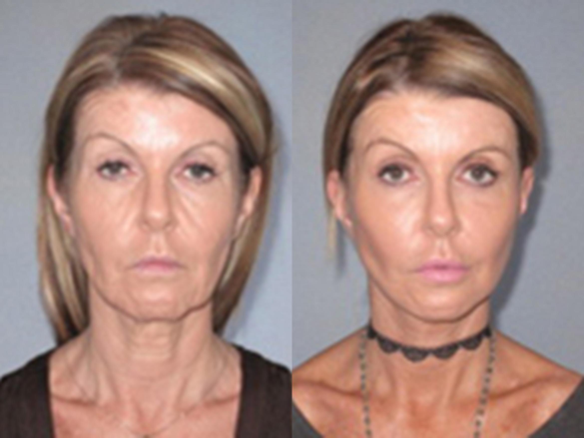 Before & After Facelift Case 93889999 View 1 View in Houston, TX