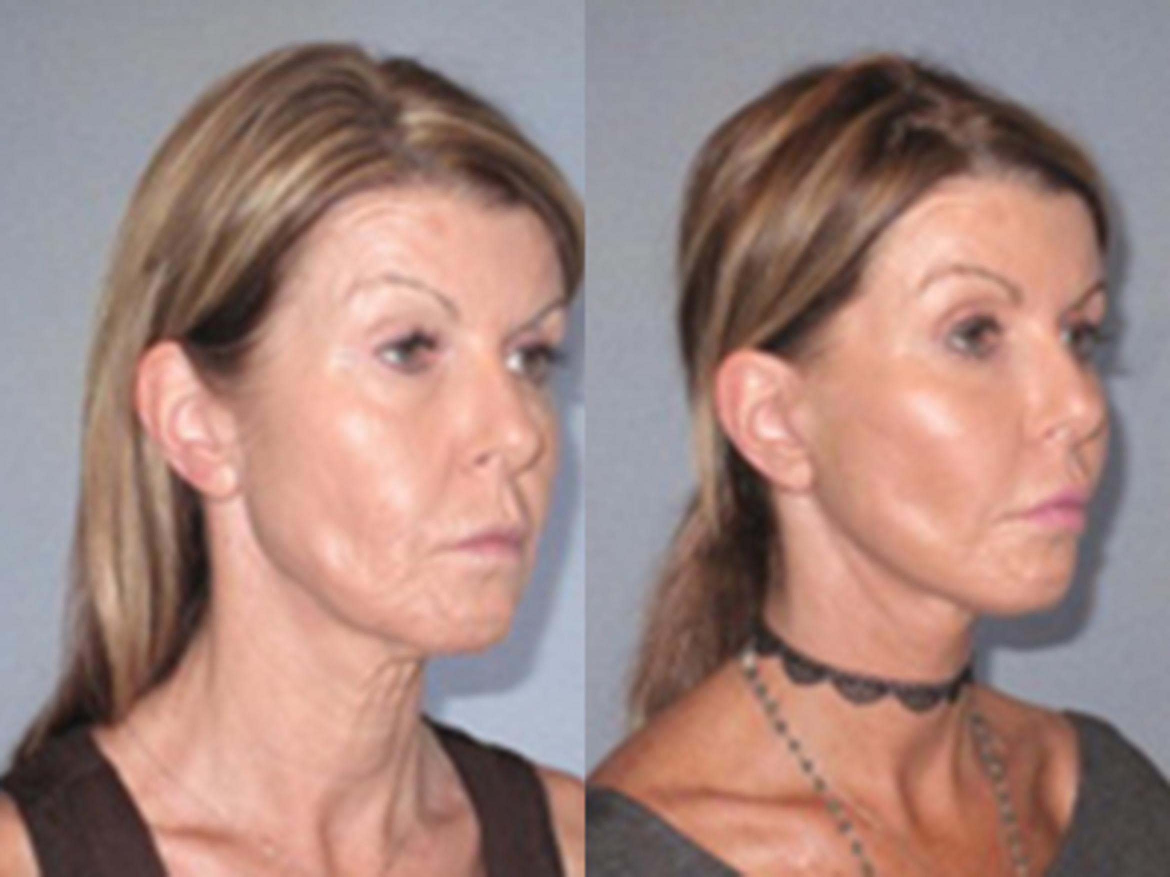 Before & After Facelift Case 93889999 View 2 View in Houston, TX