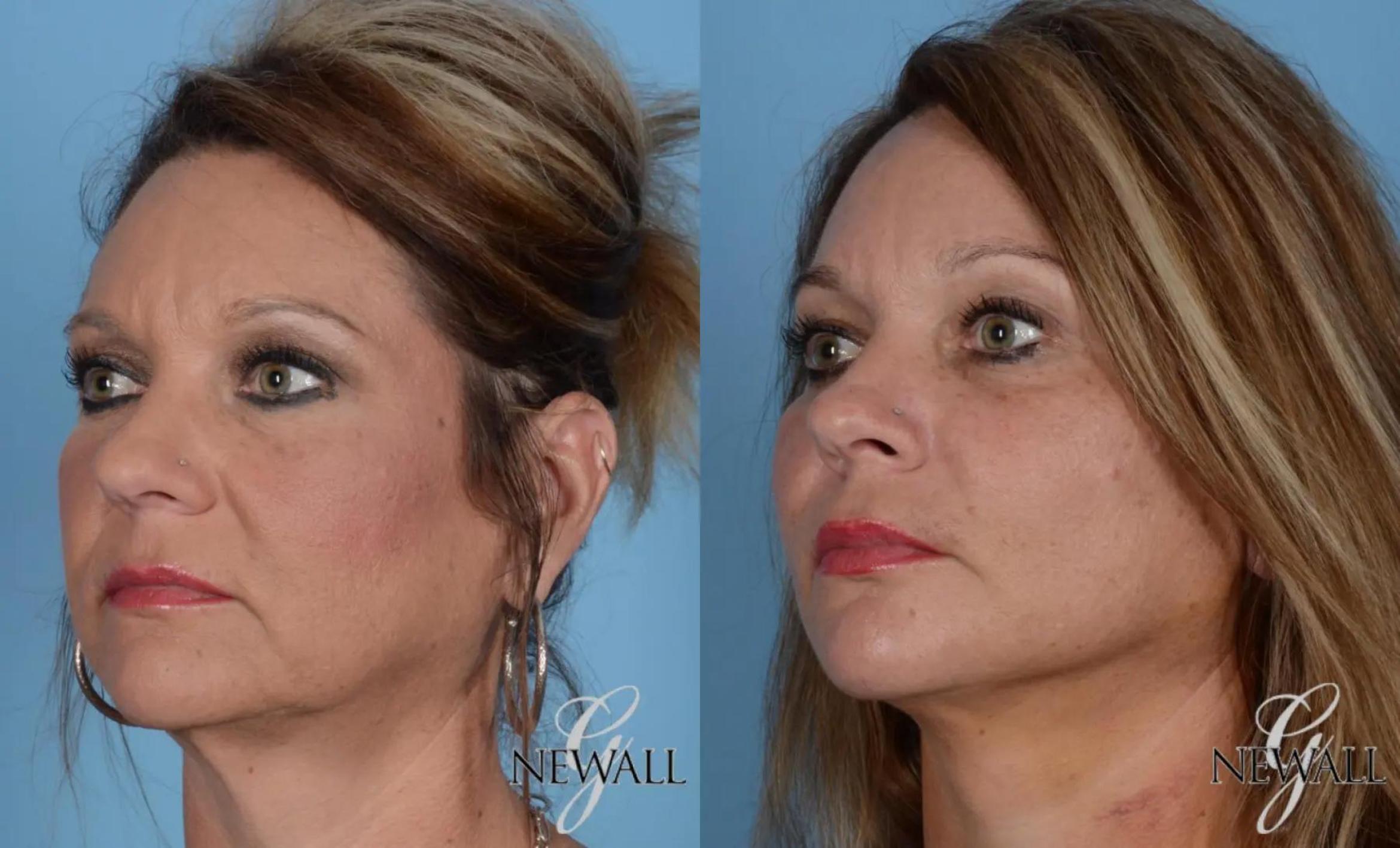 Before & After Facelift & Neck Lift Case 16973 View 2 View in Houston, TX