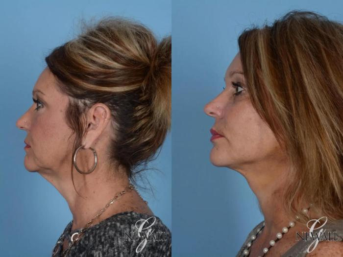 Before & After Facelift & Neck Lift Case 16973 View 3 View in Houston, TX