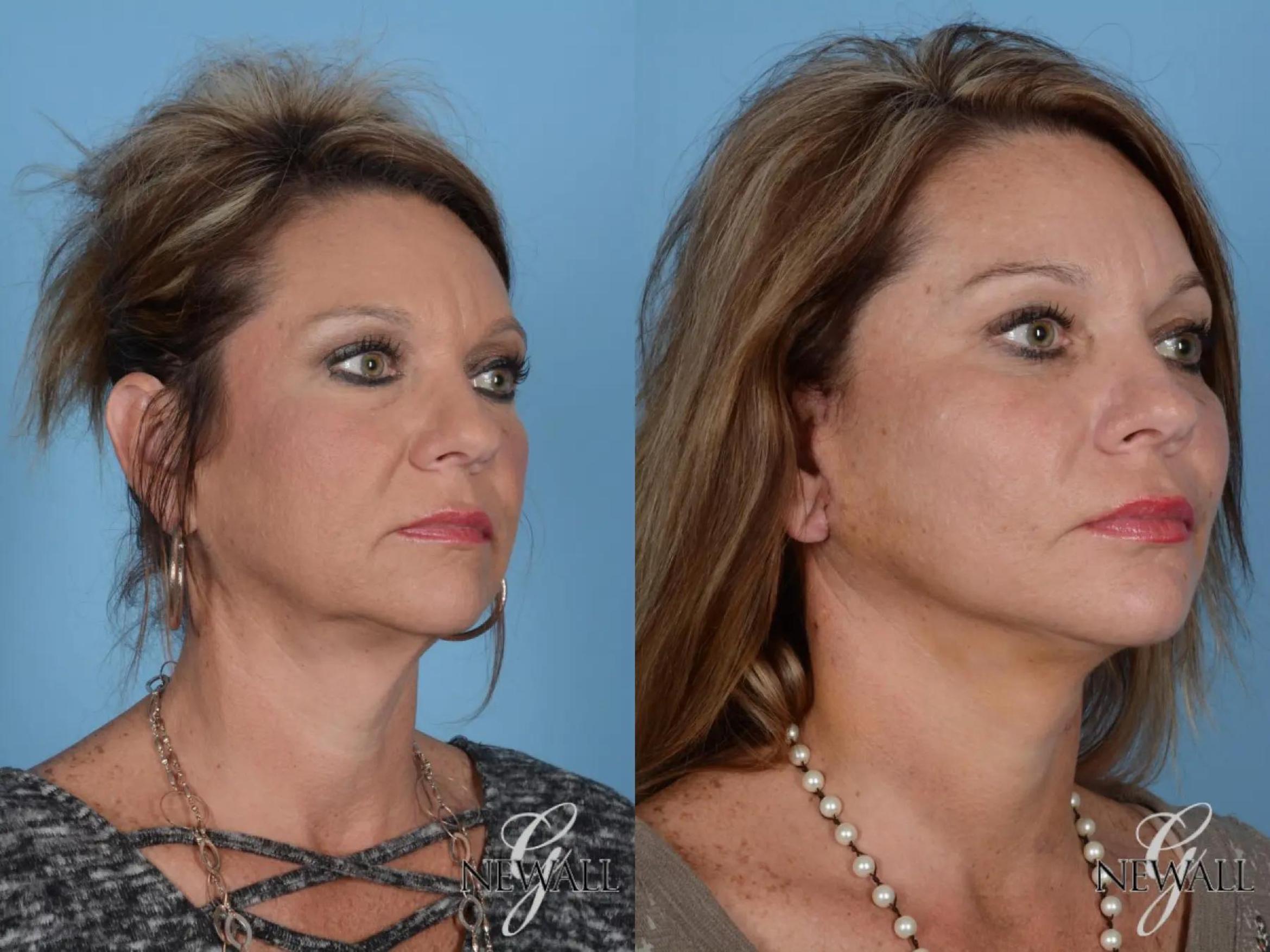 Before & After Facelift & Neck Lift Case 16973 View 4 View in Houston, TX