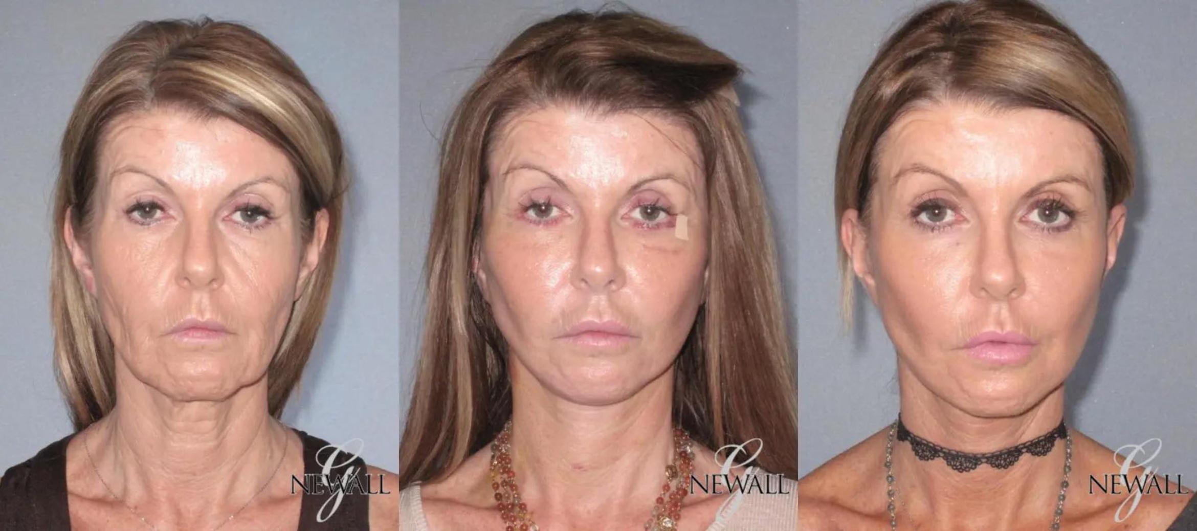 Before & After Facelift & Neck Lift Case 17564 View 1 View in Houston, TX