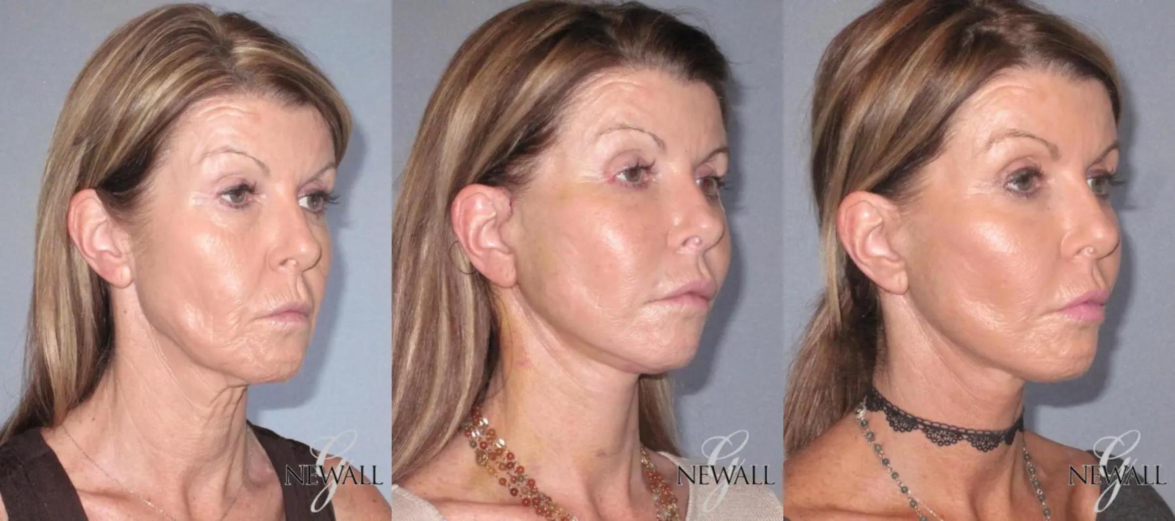 Before & After Facelift & Neck Lift Case 17564 View 2 View in Houston, TX
