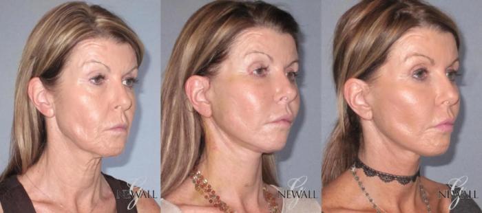 Before & After Facelift & Neck Lift Case 17564 View 2 View in Houston, TX