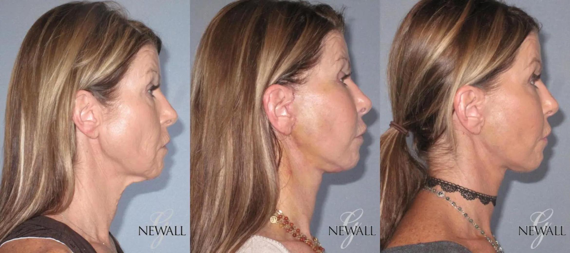 Before & After Facelift & Neck Lift Case 17564 View 3 View in Houston, TX
