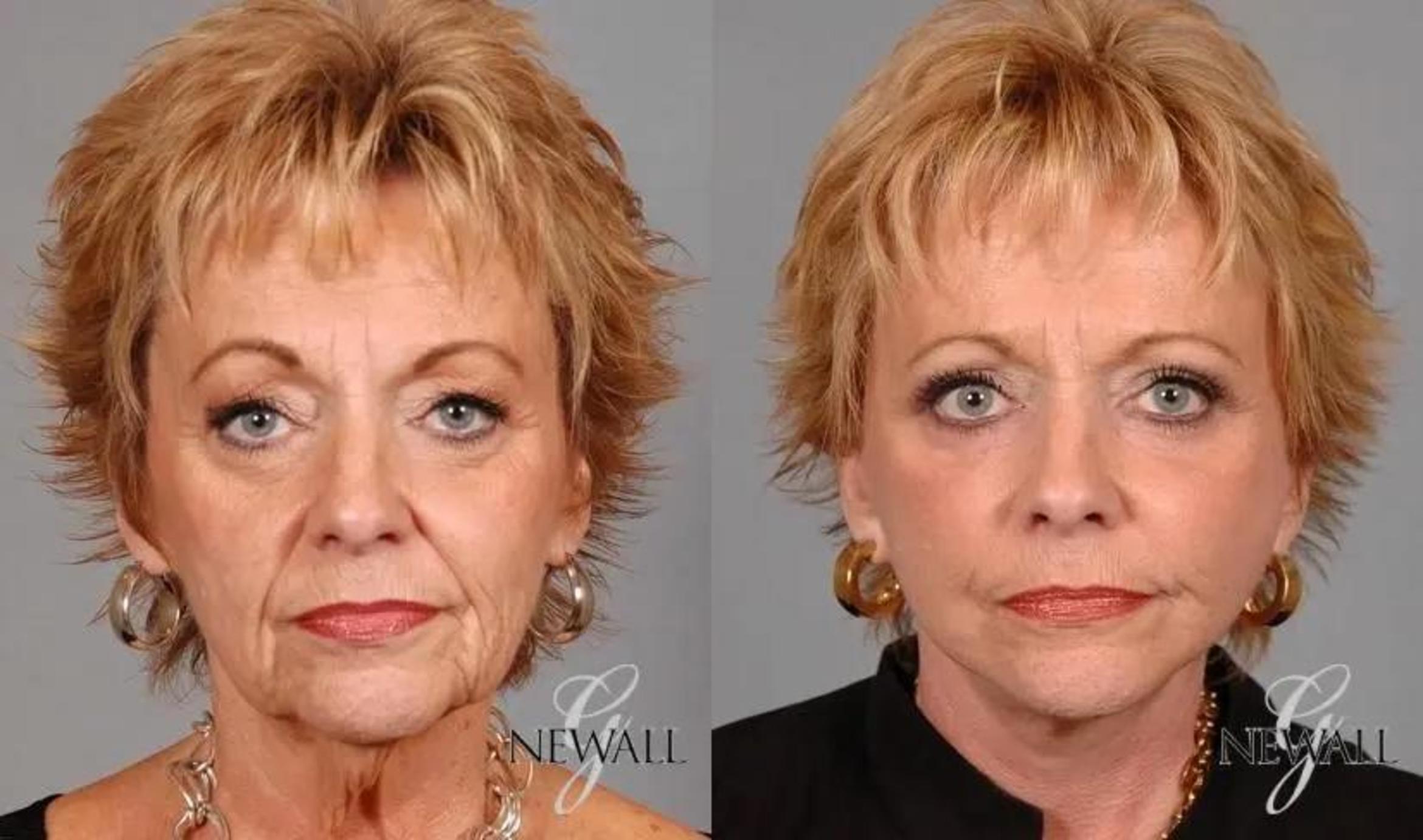 Before & After Facelift & Neck Lift Case 17568 View 1 View in Houston, TX