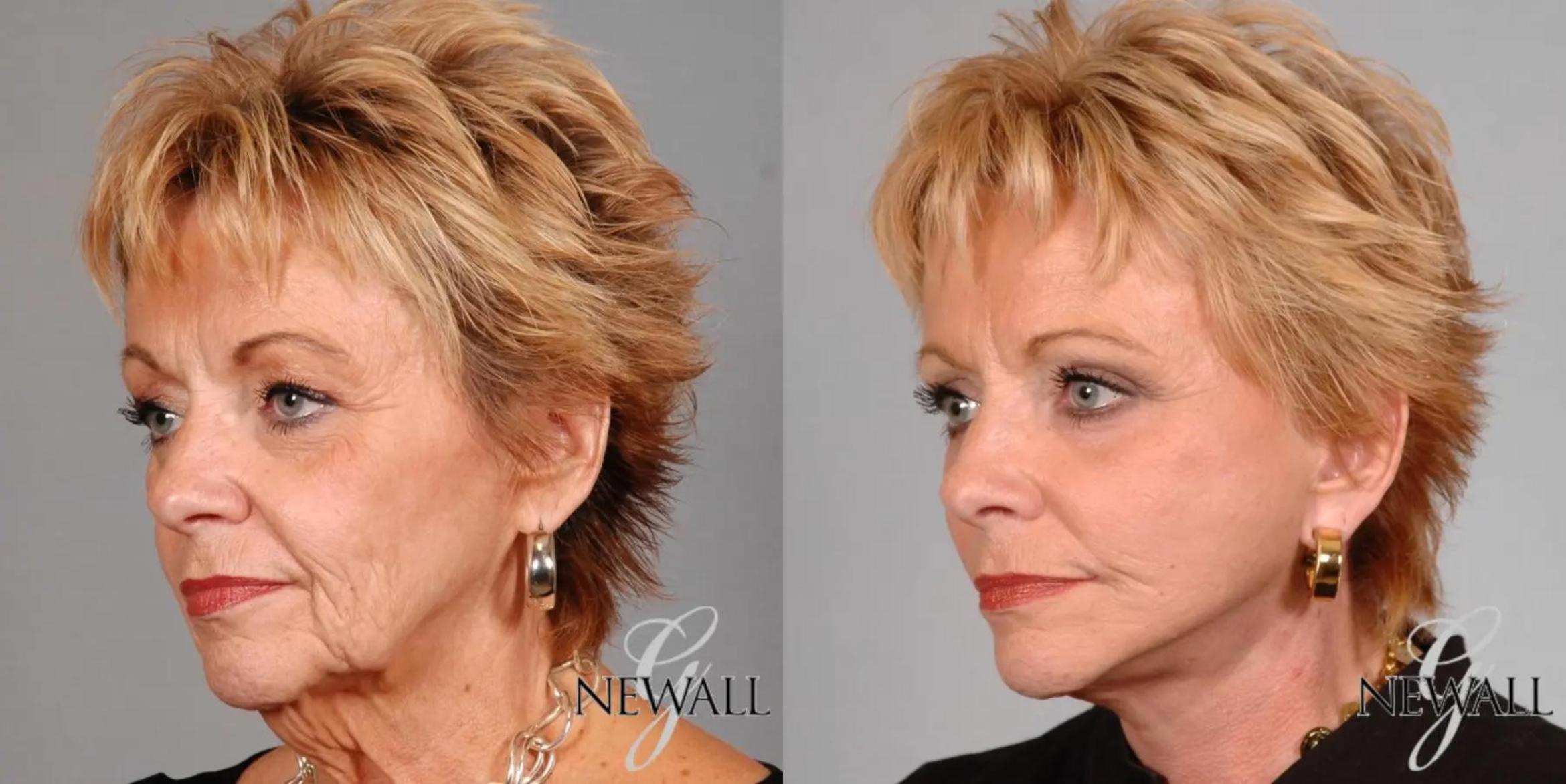 Before & After Facelift & Neck Lift Case 17568 View 3 View in Houston, TX