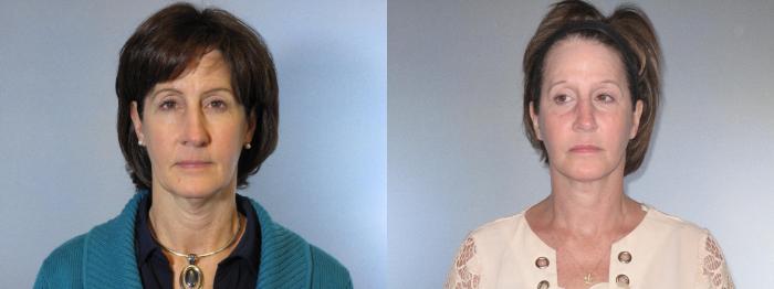 Before & After Facelift & Neck Lift Case 18154 Front 1 View in Houston, TX