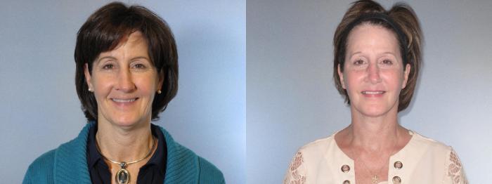 Before & After Facelift & Neck Lift Case 18154 Front 2 View in Houston, TX