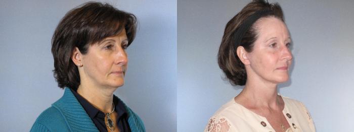 Before & After Facelift & Neck Lift Case 18154 Right Oblique (Front) View in Houston, TX