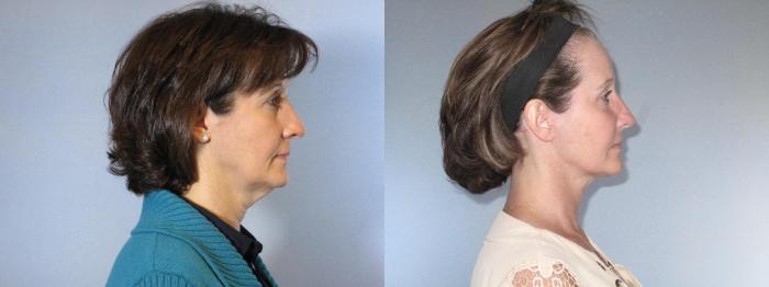 Before & After Facelift & Neck Lift Case 18154 Right Side View in Houston, TX