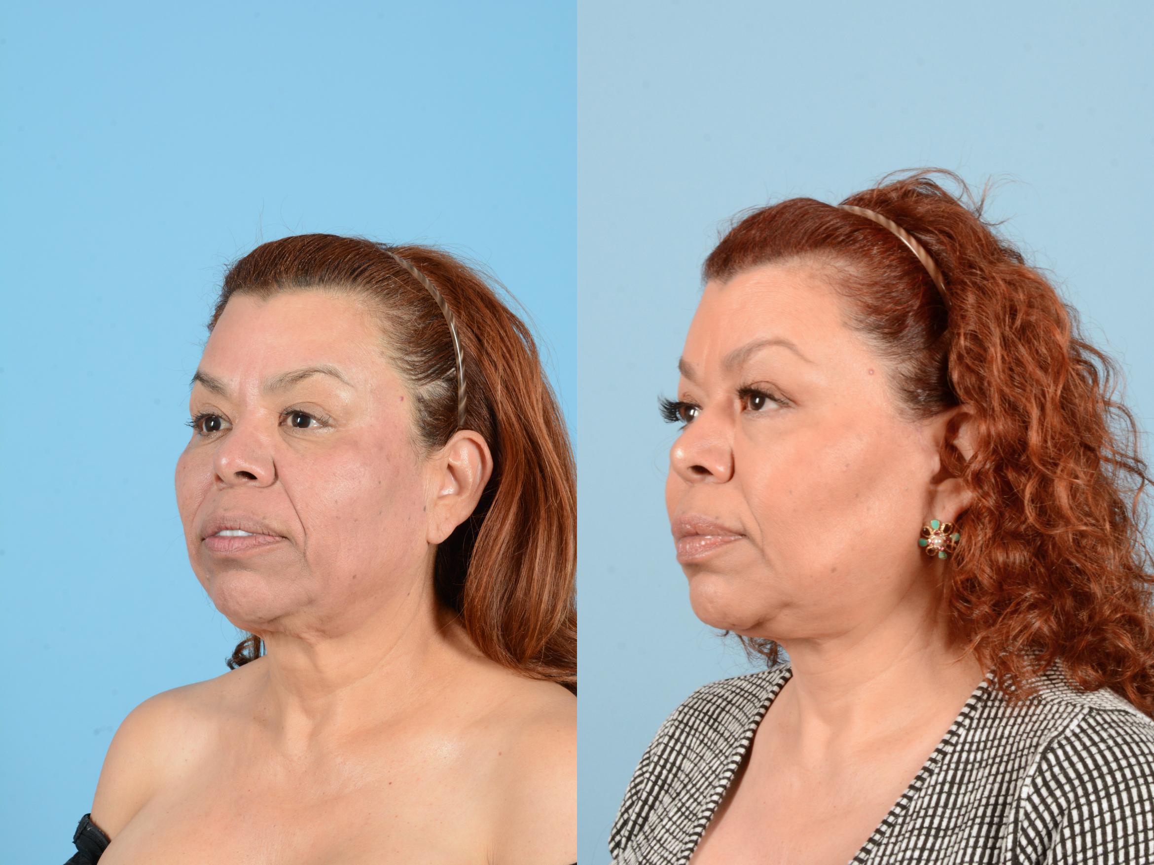 Before & After Facelift & Neck Lift Case 18161 Left Oblique (Front) View in Houston, TX