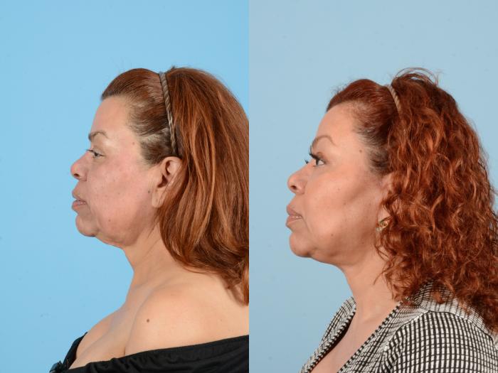 Before & After Facelift & Neck Lift Case 18161 Left Side View in Houston, TX