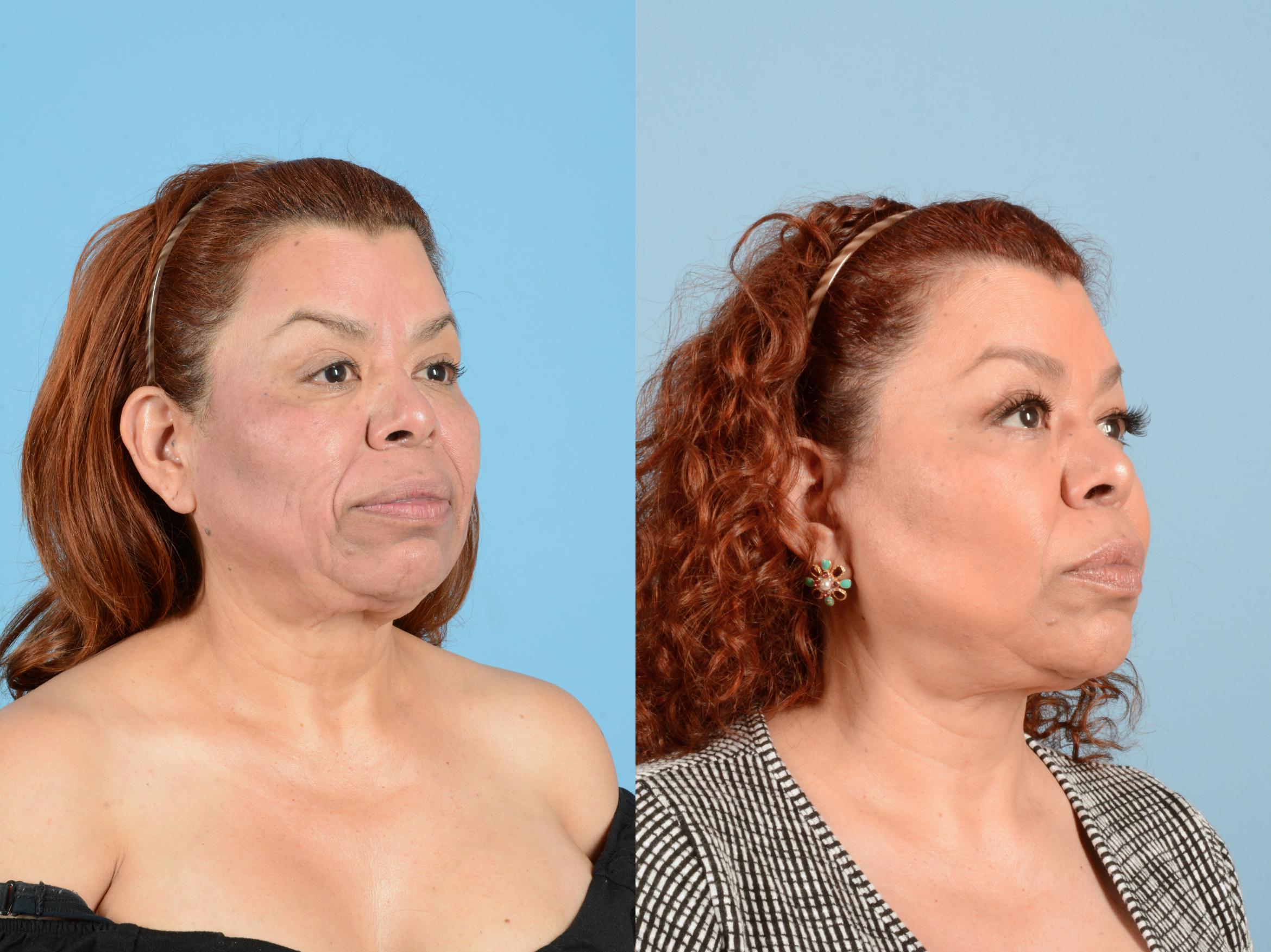 Before & After Facelift & Neck Lift Case 18161 Right Oblique (Front) View in Houston, TX