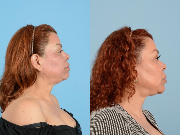 Before & After Facelift & Neck Lift Case 18161 Right Side View in Houston, TX