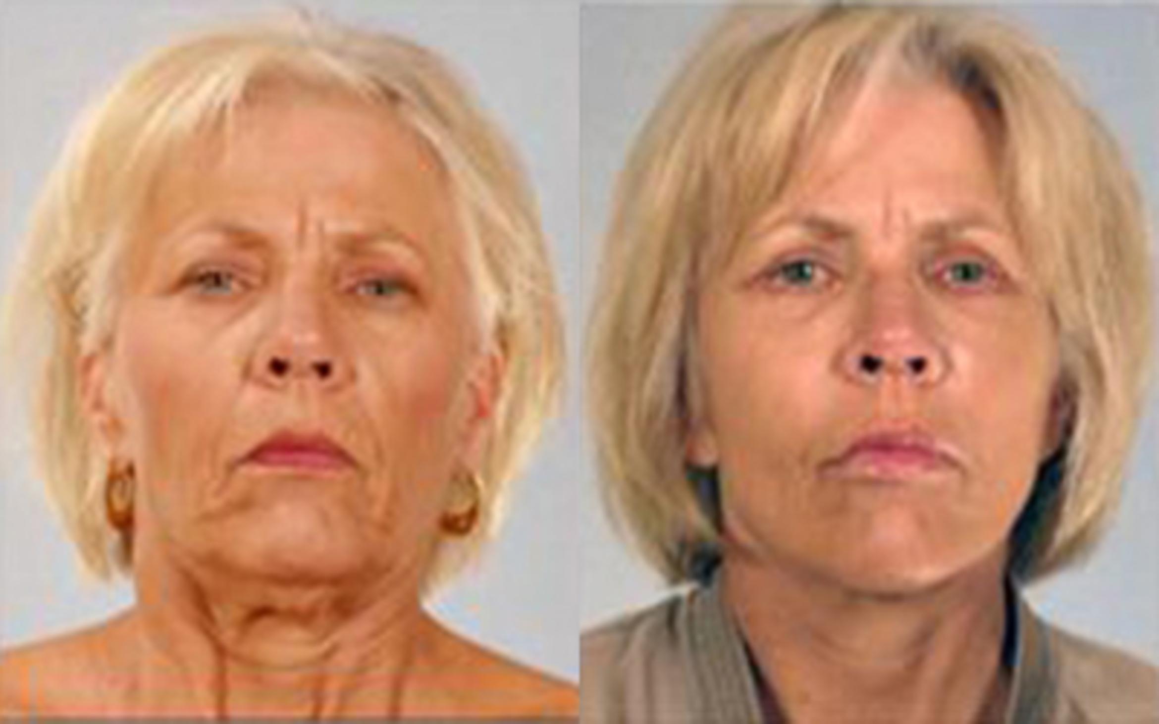 Before & After Facelift & Neck Lift Case 58139999 View 1 View in Houston, TX