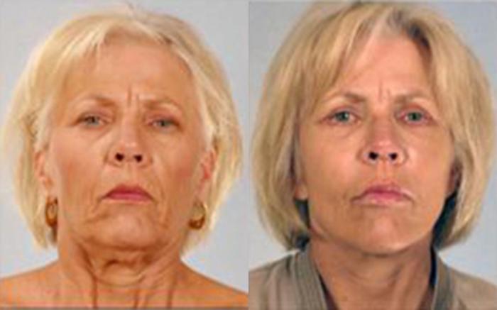 Before & After Facelift & Neck Lift Case 58139999 View 1 View in Houston, TX