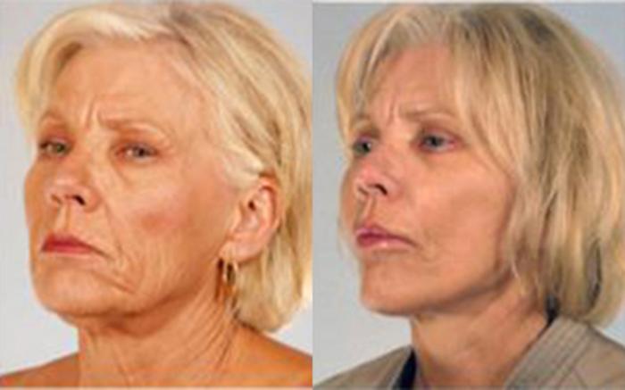 Before & After Facelift & Neck Lift Case 58139999 View 2 View in Houston, TX