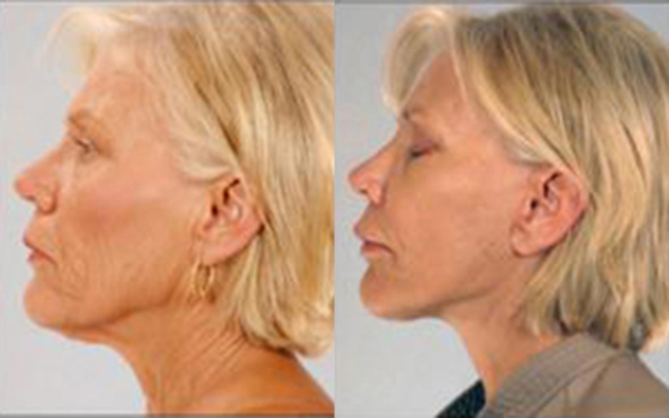 Before & After Facelift & Neck Lift Case 58139999 View 3 View in Houston, TX