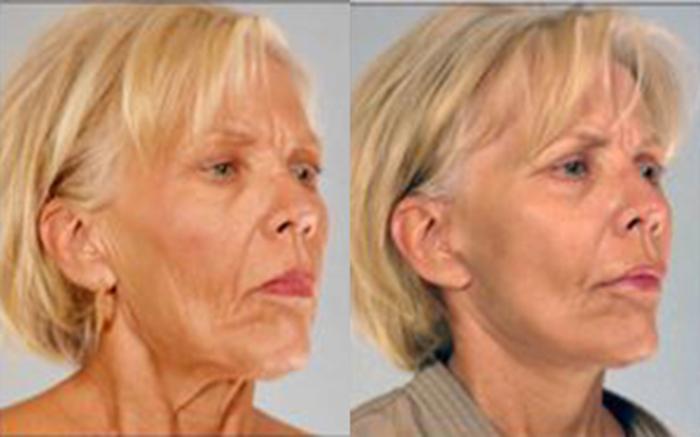 Before & After Facelift & Neck Lift Case 58139999 View 4 View in Houston, TX