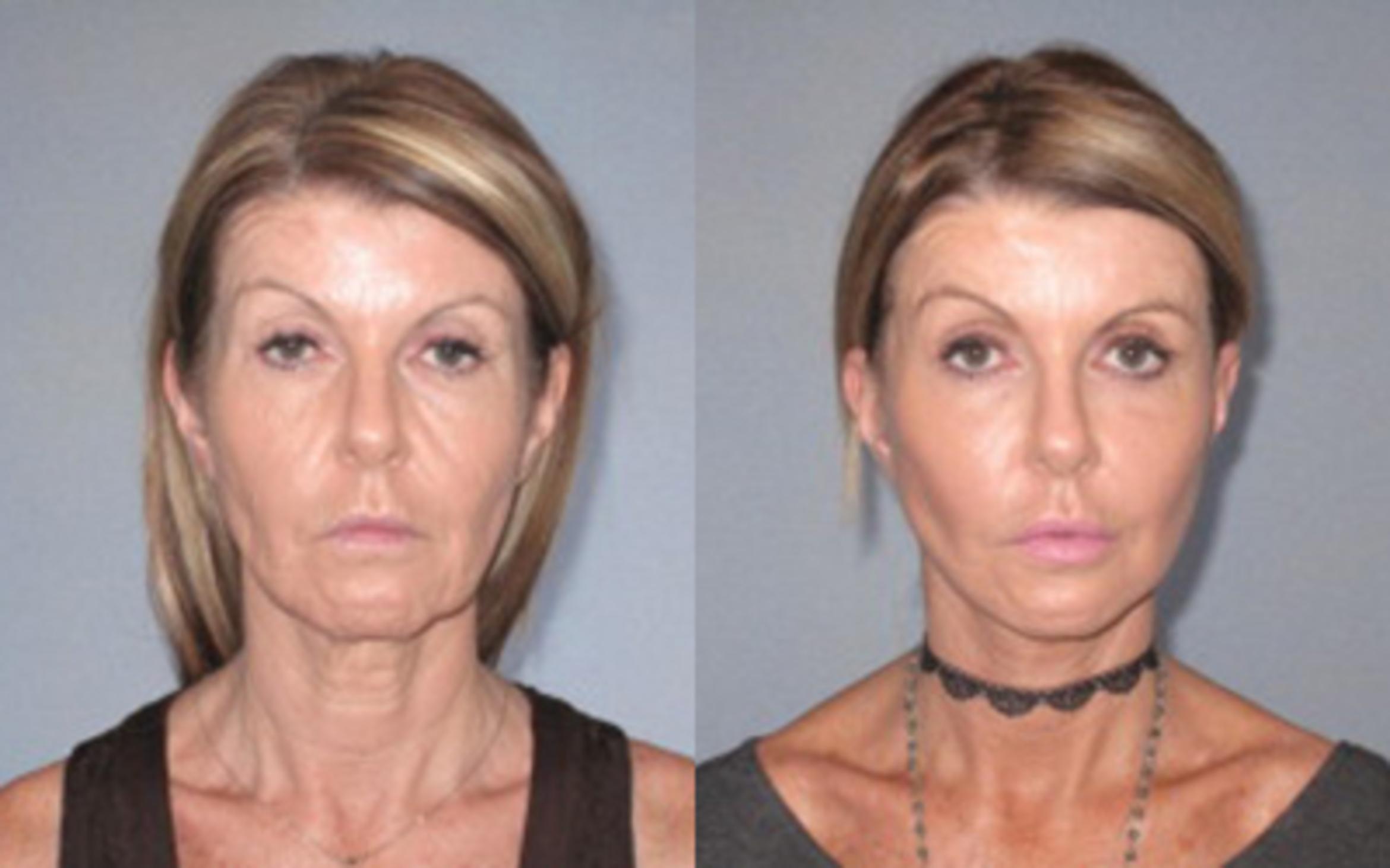 Before & After Facelift & Neck Lift Case 93889998 View 1 View in Houston, TX