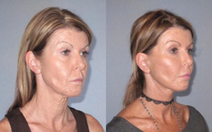Before & After Facelift & Neck Lift Case 93889998 View 2 View in Houston, TX