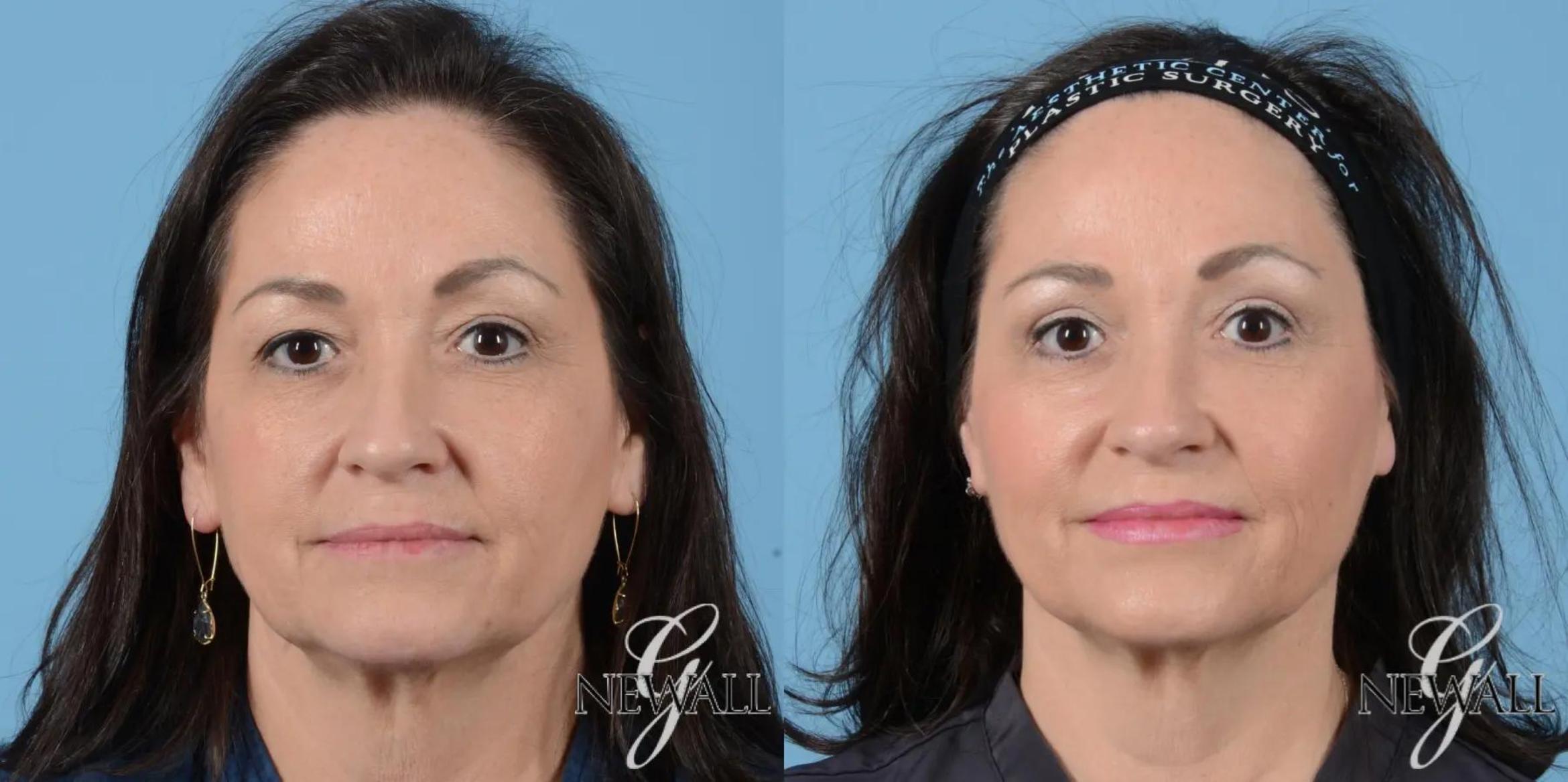 Before & After Facial Fat Grafting Case 17021 View 1 View in Houston, TX