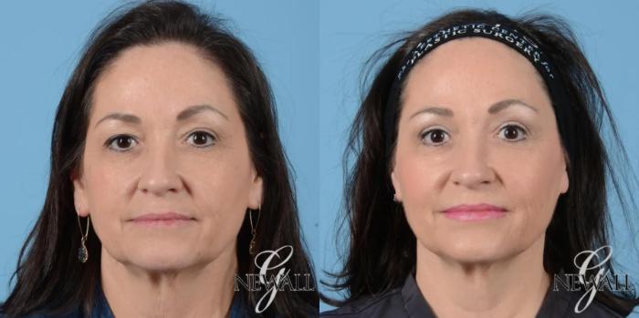 Before & After Facial Fat Grafting Case 17021 View 1 View in Houston, TX