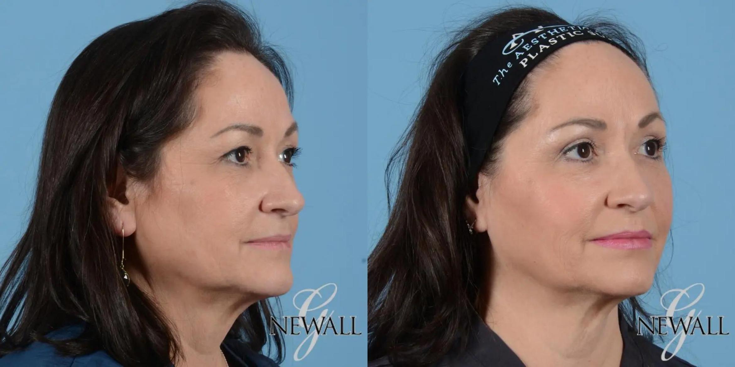 Before & After Facial Fat Grafting Case 17021 View 2 View in Houston, TX