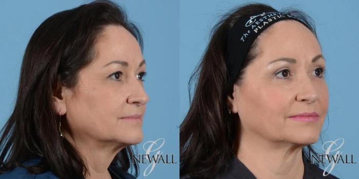 Before & After Facial Fat Grafting Case 17021 View 2 View in Houston, TX
