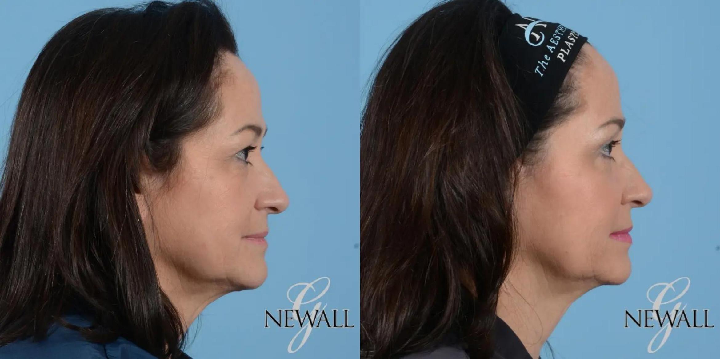 Before & After Facial Fat Grafting Case 17021 View 3 View in Houston, TX
