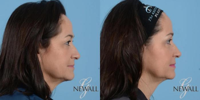 Before & After Facial Fat Grafting Case 17021 View 3 View in Houston, TX