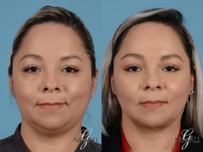 Before & After Facial Fat Grafting Case 17454 View 1 View in Houston, TX
