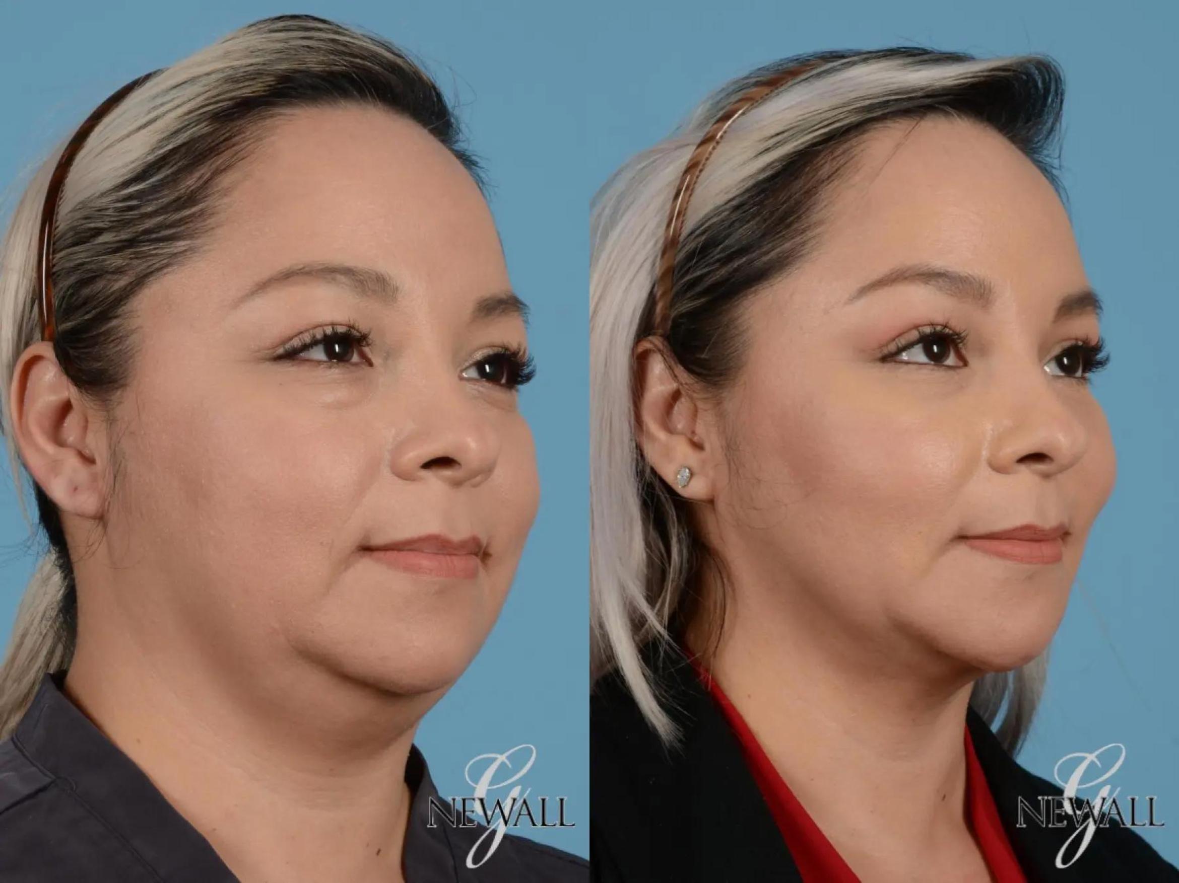 Before & After Facial Fat Grafting Case 17454 View 2 View in Houston, TX
