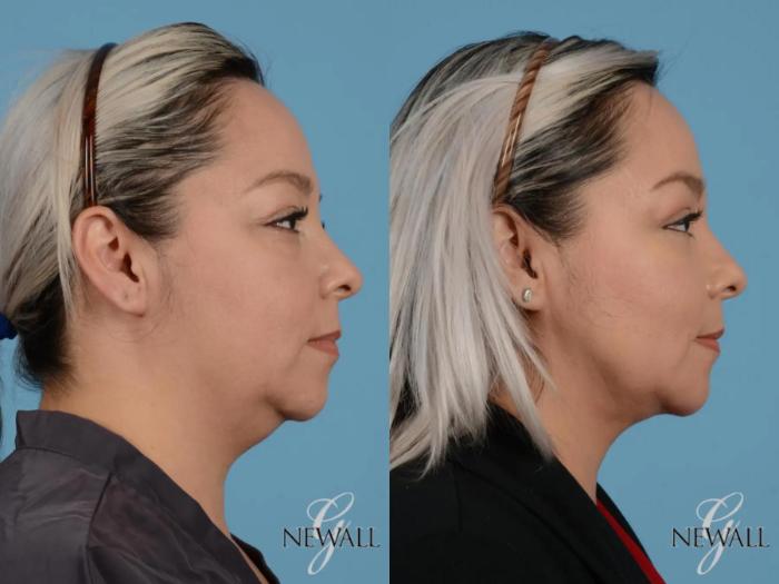 Before & After Facial Fat Grafting Case 17454 View 3 View in Houston, TX