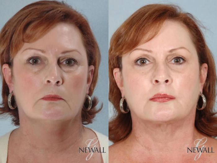 Before & After Facial Fat Grafting Case 17458 View 1 View in Houston, TX