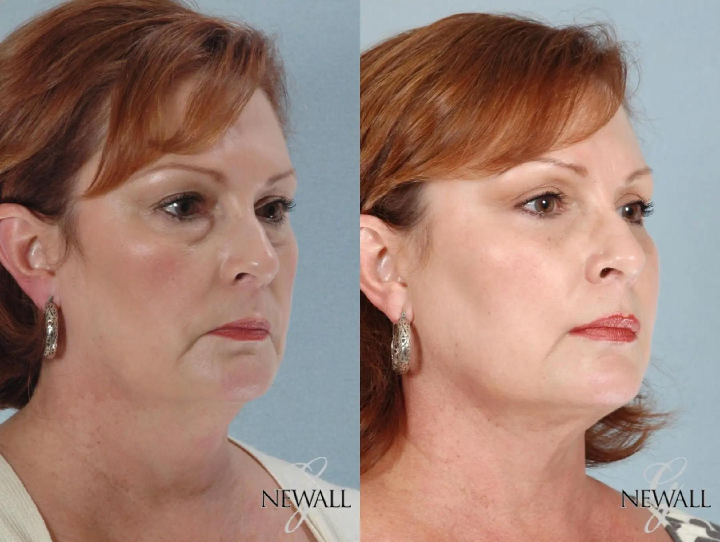 Before & After Facial Fat Grafting Case 17458 View 2 View in Houston, TX