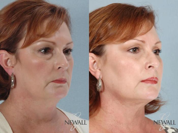 Before & After Facial Fat Grafting Case 17458 View 2 View in Houston, TX