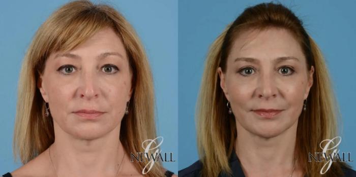Before & After Facial Fat Grafting Case 17550 View 1 View in Houston, TX