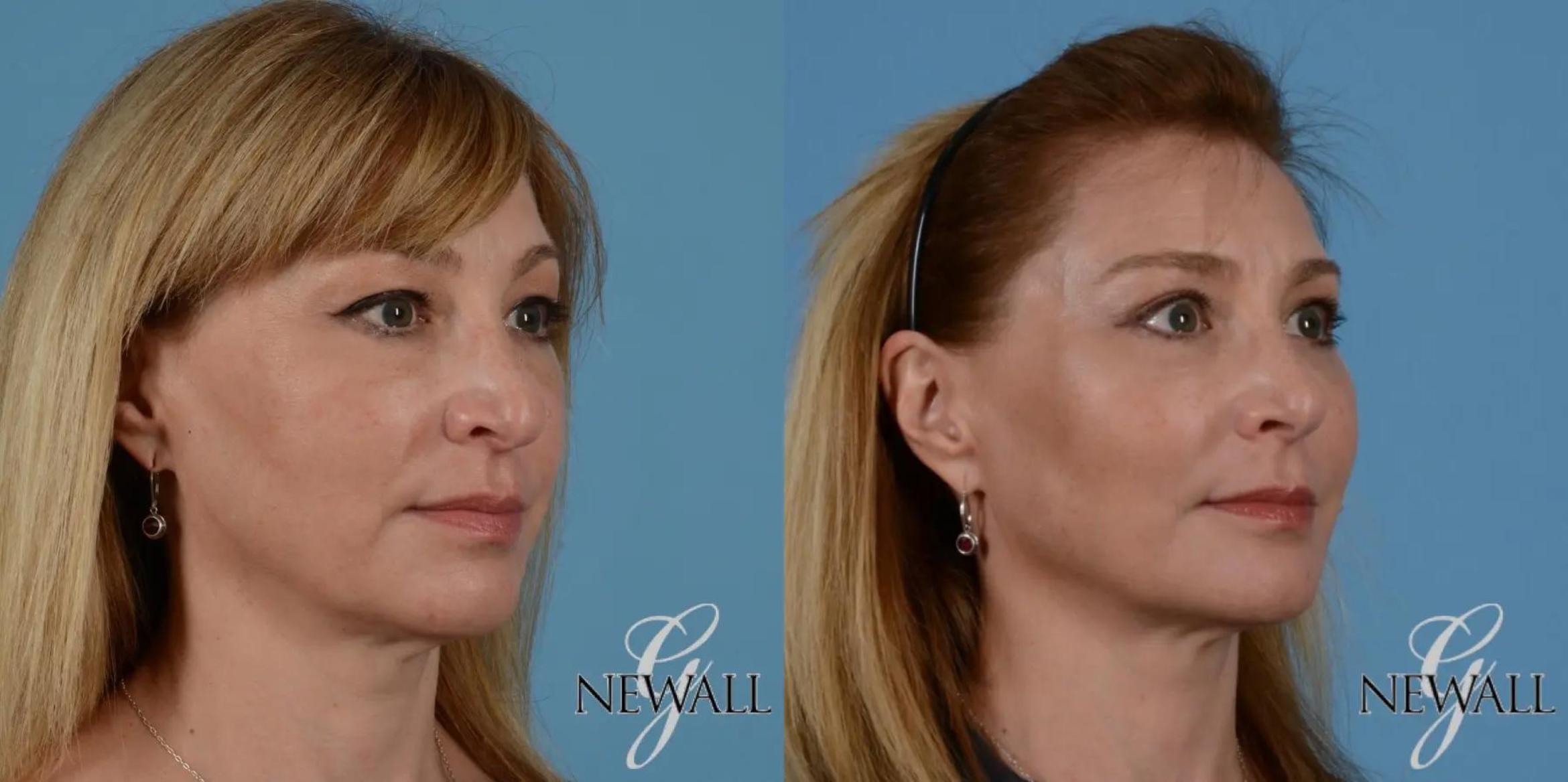 Before & After Facial Fat Grafting Case 17550 View 2 View in Houston, TX
