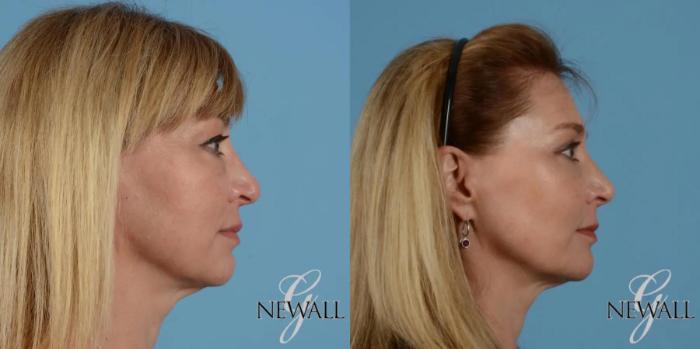 Before & After Facial Fat Grafting Case 17550 View 3 View in Houston, TX