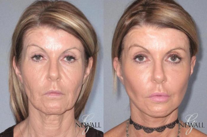 Before & After Facial Fat Grafting Case 17567 View 1 View in Houston, TX