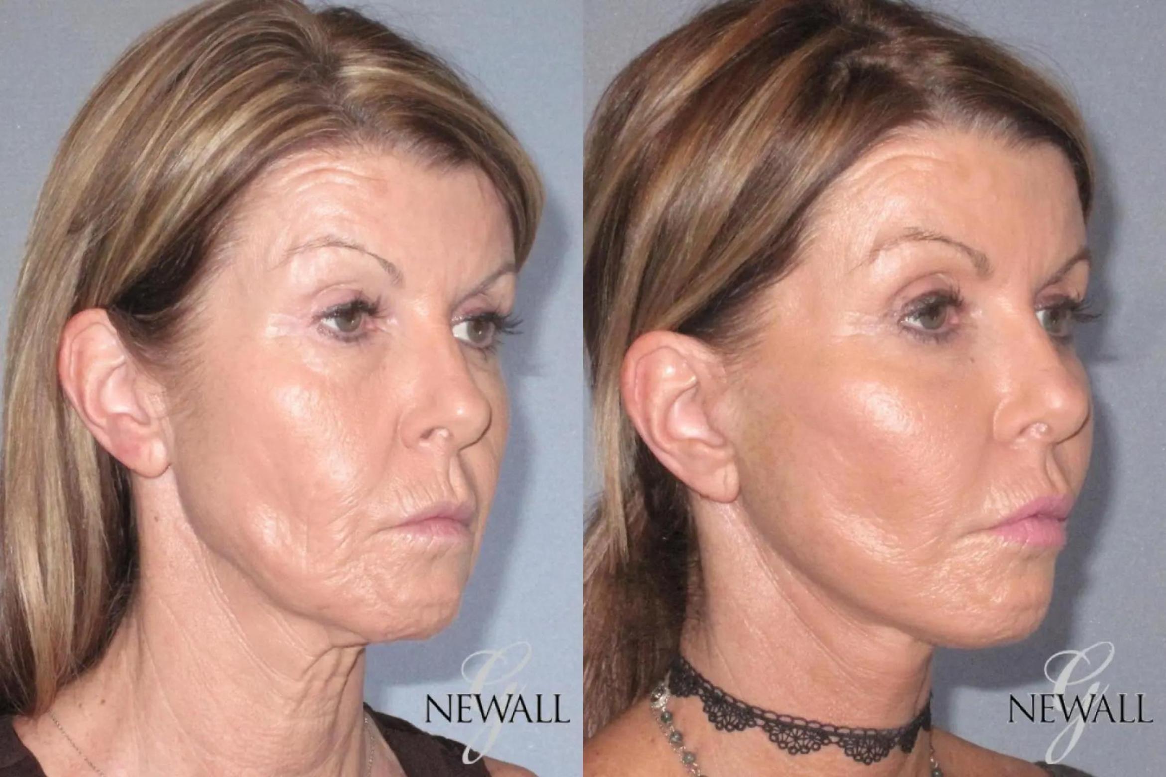 Before & After Facial Fat Grafting Case 17567 View 2 View in Houston, TX
